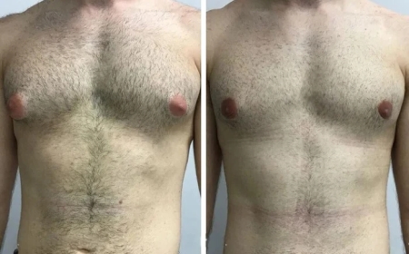 Gynecomastia in Dubai: A Comprehensive Guide for Expats