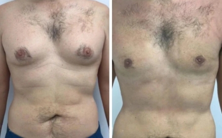 Why You Should Choose the Best Gynecomastia Surgeons in dubai for a Safe Procedure
