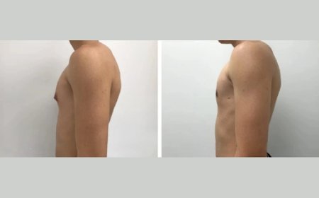 Finding the Best Gynecomastia Surgeon in Dubai for Your Gynecomastia Surgery
