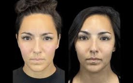 The Best Aesthetic Clinic in Dubai for Botox: Why Experience and Expertise Matter