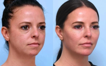 Best Aesthetic Clinic in Dubai: Achieve Youthful Contours with a Thread Lift