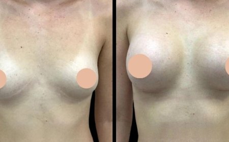 Top Reasons Why You Should Consider Breast Augmentation in Dubai