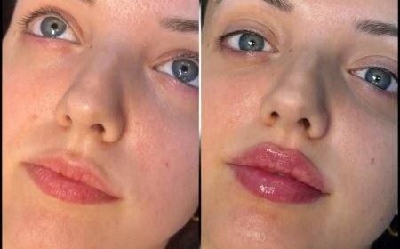 Best Aesthetic Clinics in dubai for Fillers: What to Expect During the Healing Process