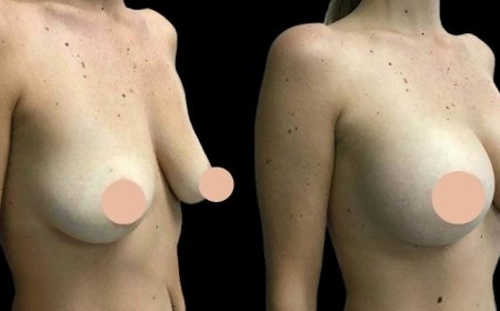 Breast Augmentation for Confidence: Insights from the Best Doctors in Dubai