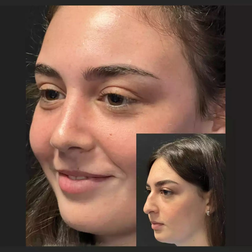 The Emotional and Psychological Benefits of Rhinoplasty in Dubai