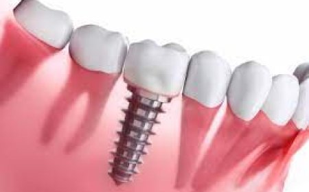 De Voordelen en Werkwijze van een Tandheelkundige Implantaat Behandeling