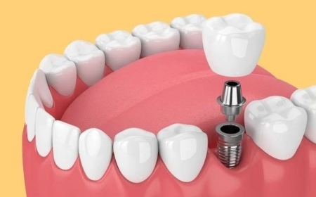 Tout savoir sur le traitement implants dentaires : une solution durable pour un sourire parfait